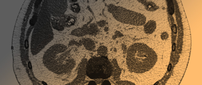 Acute Kidney Injury Triggered by Low-Dose Acetazolamide Used for the Prevention of Acute Mountain Sickness