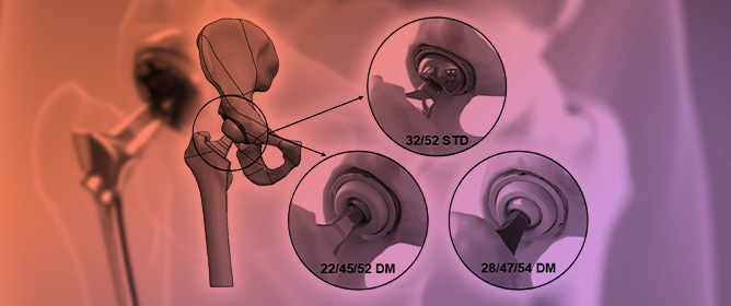 Comparing Impingement in Standard Versus Dual Mobility Hip Replacements