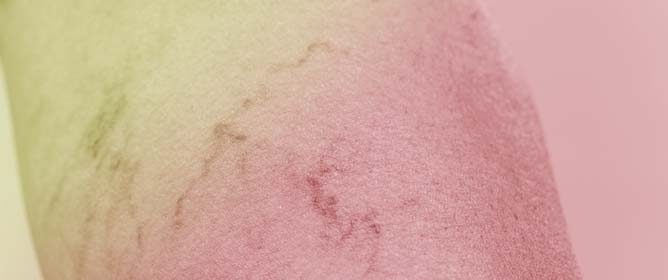 From Data to Decisions: AI in Varicose Veins&mdash;Predicting, Diagnosing, and Guiding Effective Management
