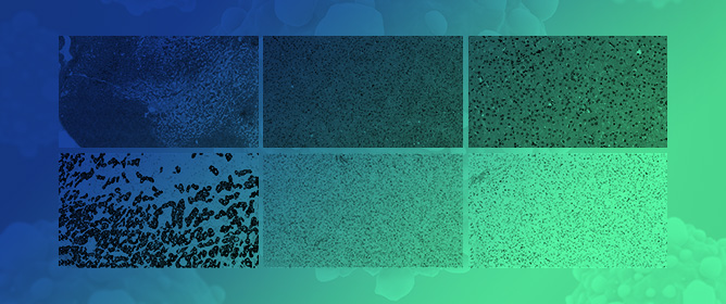 L1CAM Reliably Distinguishes Low-Grade Oncocytic Tumor from Other Eosinophilic Renal Neoplasms: A Multicenter Immunohistochemical Study with Diagnostic Implications