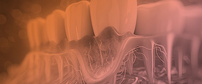 Novel Assessment of Protein Gingival Carbonylation in Periodontal Disease and Diabetes