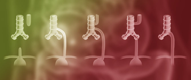 Innovations in Minimally Invasive Management of Esophageal Atresia and Tracheoesophageal Fistula