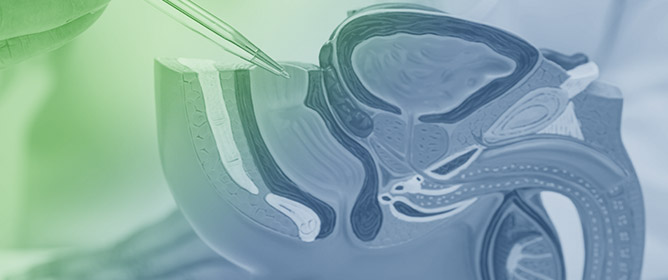 Intraurethral Steroid and Clean Intermittent Self-Dilatation for Lichen Sclerosus Proven Urethral Stricture Disease&mdash;A Retrospective Cohort Study