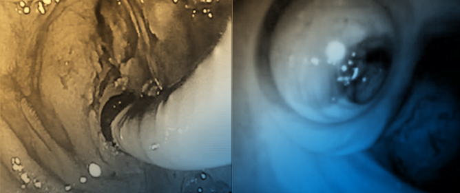 Western Experience of Hepatolithiasis: Clinical Insights from a Case Series in a Tertiary Center