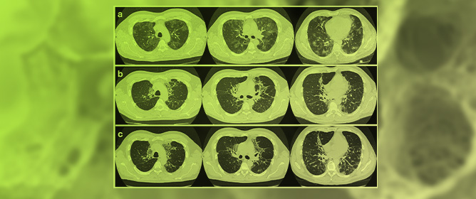 Fibrotic Chronic Eosinophilic Pneumonia Treated with an Anti-IL-5 Monoclonal Antibody: A Case Report