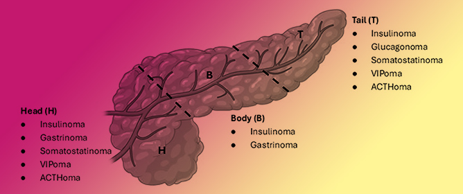 Functional Pancreatic Neuroendocrine Neoplasms: An Overview