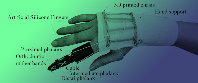 A Body-Powered Underactuated Prosthetic Finger Driven by MCP Joint Motion