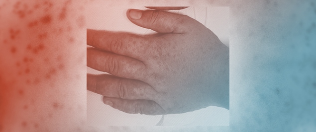 Could the Identification of Skin Lesions Be Beneficial for the Differential Diagnosis of Viral Meningitis?