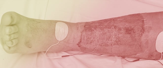 Does Electrical Stimulation Improve Burn Healing?