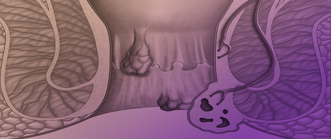 Improving Hemorrhoid Outcomes: Best Practices for Pharmacists