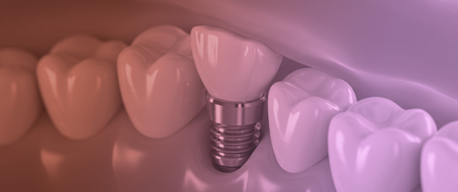 Fully Digital Workflow in Full-Arch Implant Rehabilitation: A Descriptive Methodological Review