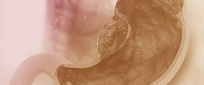 Impact of Endoscopic Band Ligation on Gastric Complications Associated with Portal Hypertension