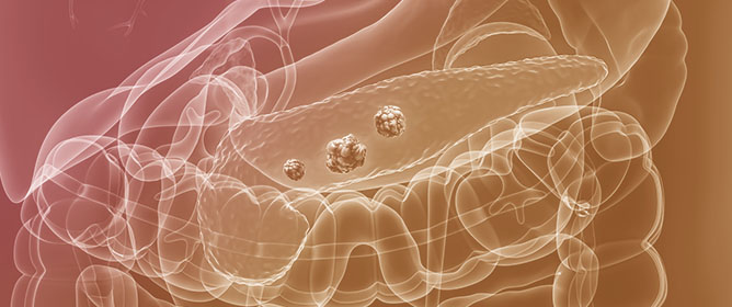 Targeting Advanced Pancreatic Ductal Adenocarcinoma: A Practical Overview