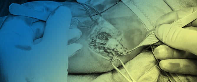 Short-Term Outcomes of a Novel Fascio-Aponeurotic Flap Technique for Ulnar Nerve Instability at the Elbow
