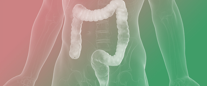 Design of an Array to Evaluate Biomarkers of Response to Biological Treatments in Inflammatory Bowel Disease