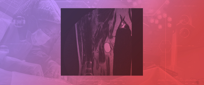 Spontaneous Muscle Bleeding During Oral Anticoagulation Therapy: When Should We Suspect an Underlying Tumor?