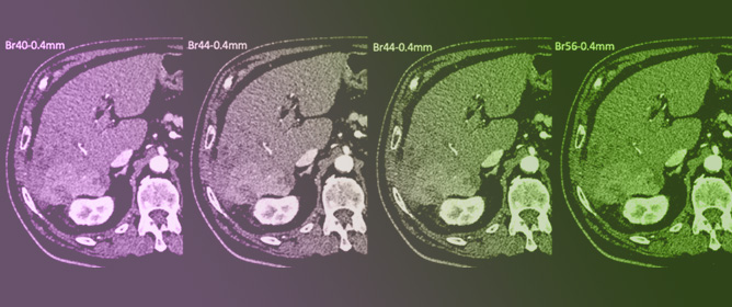 Optimal Image Reconstruction Settings for HCC Imaging in Photon-Counting CT