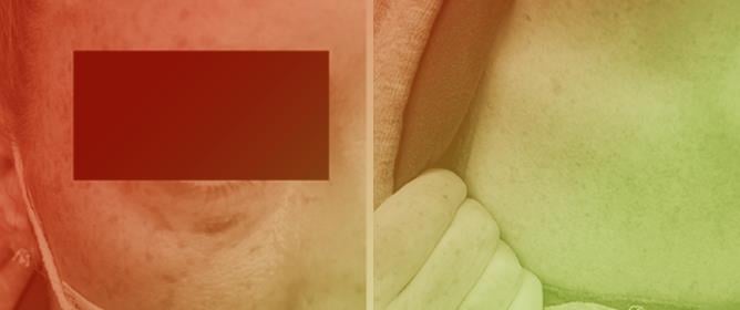 Cutaneous Manifestations of Liver Cirrhosis: Clinical Significance and Diagnostic Implications