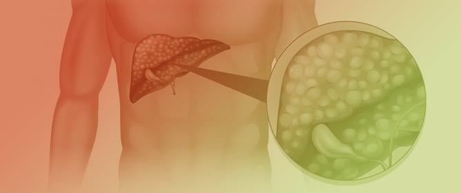 Low Hepatic CEACAM1 Tethers Metabolic Dysfunction Steatohepatitis to Atherosclerosis