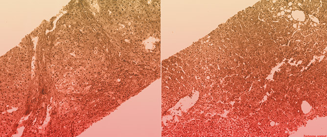 Challenging the Dogma: Reversal of End-Stage Liver Fibrosis with Tirzepatide in MASH Cirrhosis
