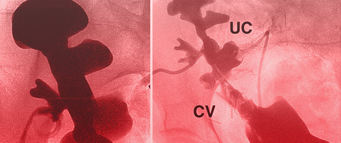 Calycovesicostomy, Ureterocalycostomy, and Ileocalycostomy: Rare Reconstructive Options for Transplant Ureteral Strictures