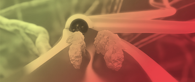 Characteristics and Demographics of Patients Younger than 50 with Atherosclerotic Cardiovascular Disease