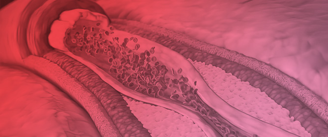 Multiple Arterial Grafting in CABG: Outcomes, Concerns, and Controversies