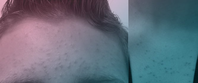 <em>Malassezia</em> Folliculitis: An Underdiagnosed Mimicker of Acneiform Eruptions