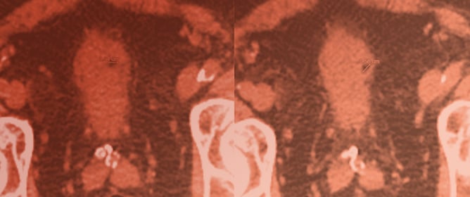 A Literature Review of Phantom Bladder Perforation: The Curious Case of Bladder Lipoma