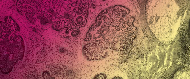 Increased Detection of Merkel Cell Polyomavirus in Non-Melanoma Skin Cancer and Its Association with Host Immunogenetic Profile