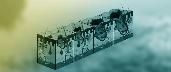 Promising Nanotechnology-Based Strategies for Melanoma Treatment