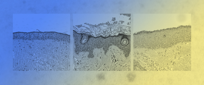 Dermal Mitoses Correlate with Surgical Burden in Lentigo Maligna Melanoma: PRAME for Margin Assessment