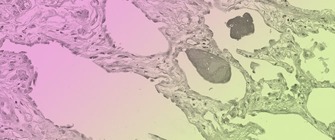 Serial Anti-GM-CSF Autoantibody Levels Reflect Disease Activity in Hypersensitivity Pneumonitis with Autoimmune Pulmonary Alveolar Proteinosis: Case Report
