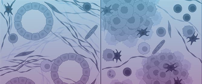 Functional Precision in Pancreatic Cancer: Redefining Biomarkers with Patient-Derived Organoids