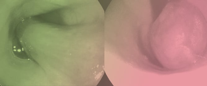 Diagnosis, Management, and Long-Term Outcome of Esophageal Plasmacytoma in a Dog