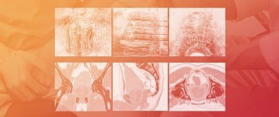 Dosimetric Comparison of VMAT Alone and VMAT with HDR Brachytherapy Boost Using Clinical and Biological Dose Models in Localized Prostate Cancer