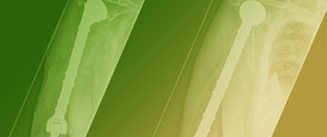 Is a Bacteriophage Approach for Musculoskeletal Infection Management an Alternative to Conventional Therapy?