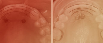 Temporary Anchorage Devices for Replacing Missing Maxillary Lateral Incisors in Growing Patients: Review and Case Study
