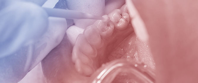 Wet vs. Dry Dentin Bonding: A Systematic Review and Meta-Analysis of Adhesive Performance and Hybrid Layer Integrity