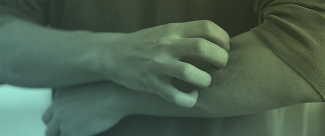 Atopic Dermatitis: Pathophysiology and Emerging Treatments