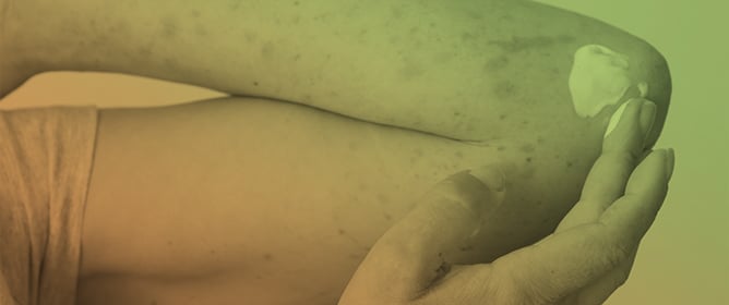 Psychiatric Comorbidities in Adult Patients with Atopic Dermatitis: A Nationwide Cohort Study Compared to Melanocytic Naevi