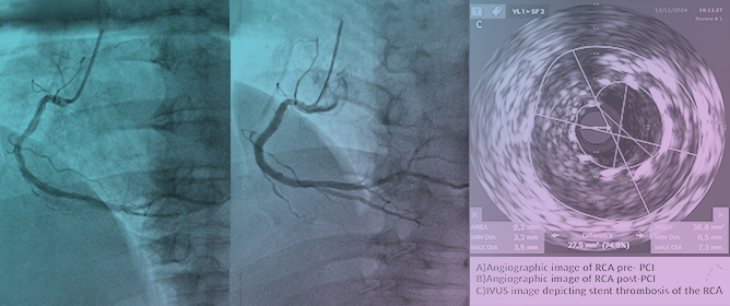 When Functional Assessment Meets Intravascular Imaging in Patients with Coronary Artery Disease