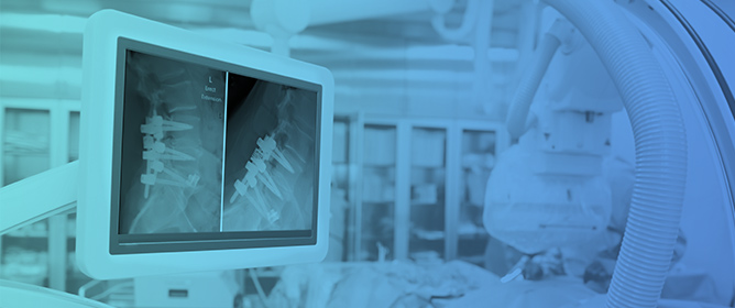 High Fusion Rates with Structured Titanium TLIF Cages: A Retrospective 1-Year Study with and Without Adjacent Level Dynamic Stabilization