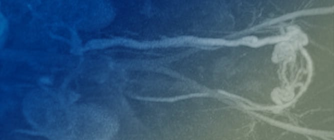 Nutcracker Syndrome as an Uncommon Cause of Isolated Hematuria in Adults