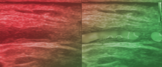 Extended Color Doppler Ultrasound Evaluation of Giant Cell Arteritis and Posterior Circulation Involvement