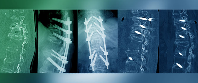 Clinical Outcomes of Transdiscal Screws for Thoracolumbar Spinal Fractures with Marked Anterior Distraction Gap Accompanied by Diffuse Idiopathic Skeletal Hyperostosis