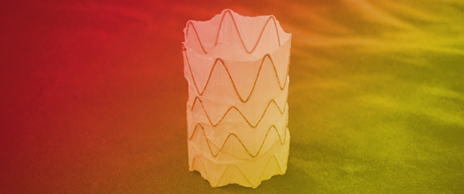 Endovascular Repair of Chronic Type B Aortic Dissection Using a New False Lumen Occlusion Device (FLOD): First Reported Case