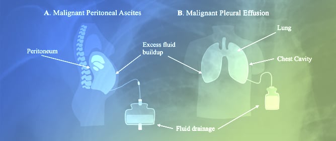 The Tumor Environment in Peritoneal Carcinomatosis and Malignant Pleural Effusions: Implications for Therapy