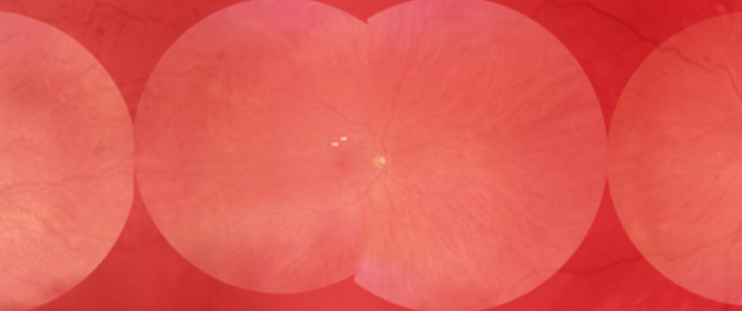 Ophthalmic Imaging in Diabetic Retinopathy and Diabetic Macular Edema: Key Findings and Advancements