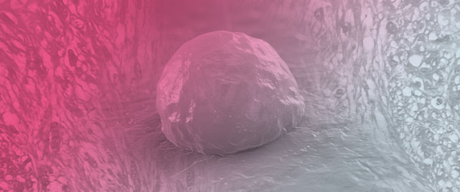 Recurrent Cutaneous Leiomyosarcoma: A Histopathological Perspective and the Quest for Complete Excision